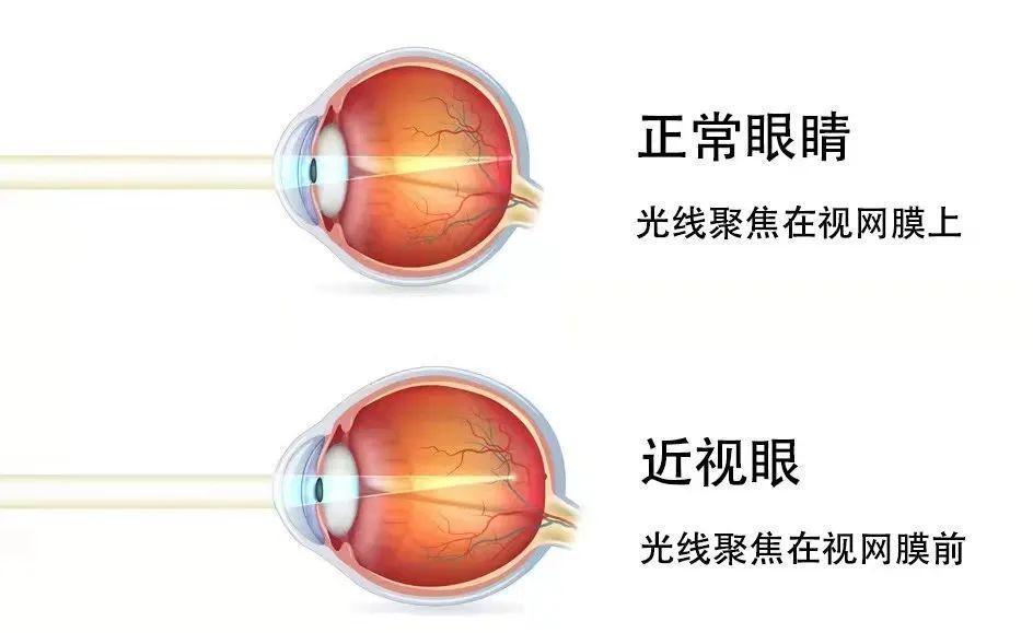 视网膜脱落|为什么近视容易导致视网膜脱离?