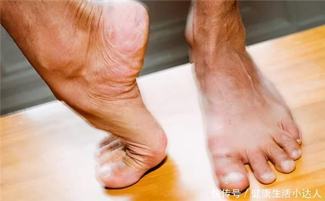 4种东西,“激活”血栓,不想心梗、脑梗找上门,尽量少碰