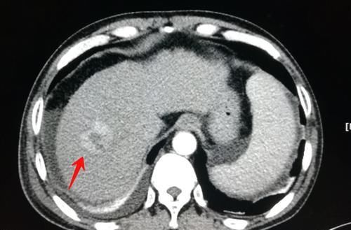 癌症患者体重增加，是好现象吧？