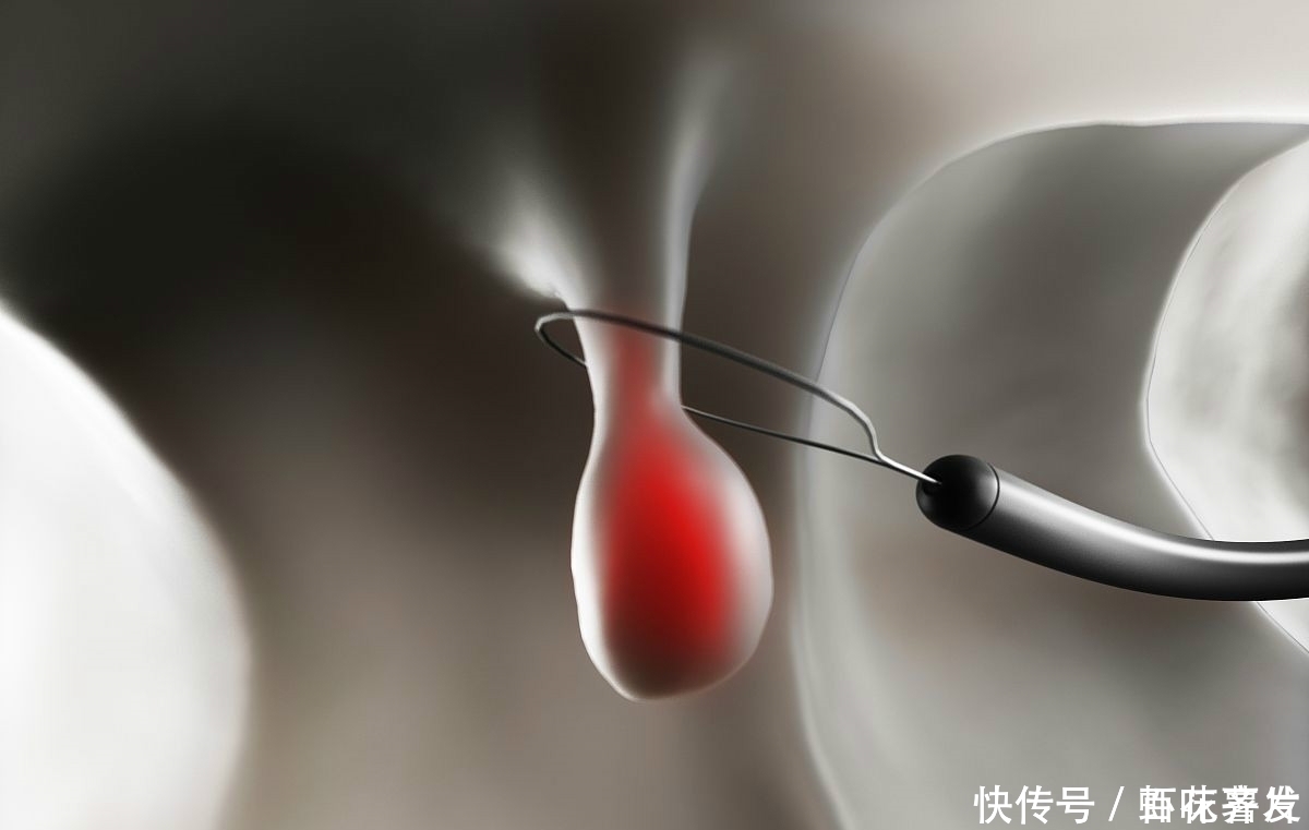 手术切除|两种息肉一定要及时切除，一拖再拖会变成恶性肿瘤