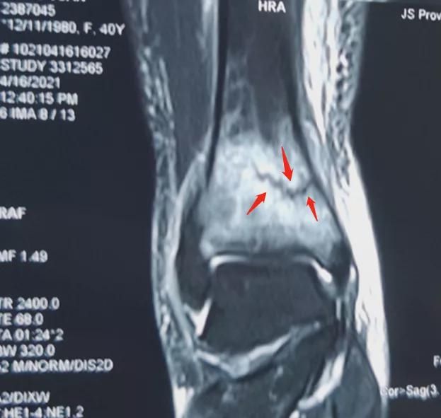陪孩子练习跳绳 结果自己骨折了