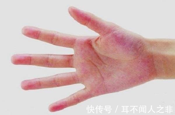 癌变|肺部发生癌变,手上三处“感觉”比较强烈,若全没有肺还很健康