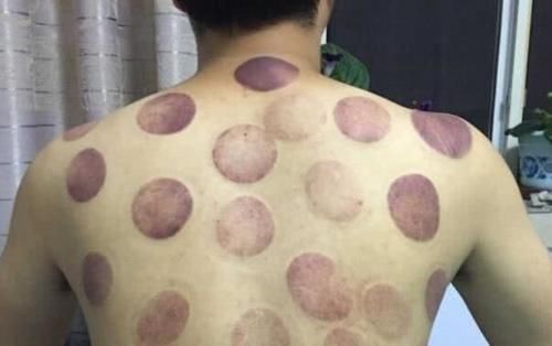 黑印|拔罐的黑印真的是体内毒素吗拔罐师傅给出解释,看完长见识了