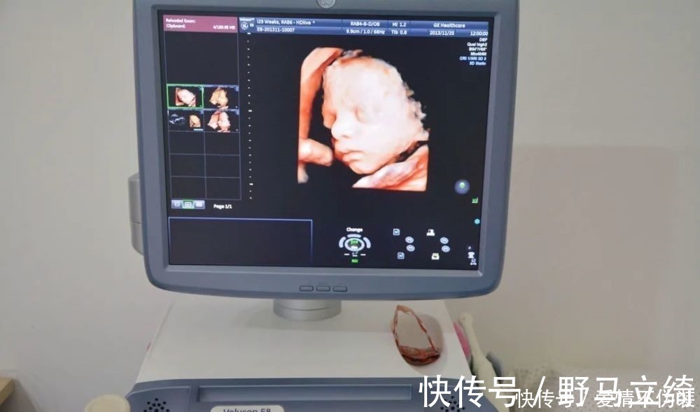 鉴定|一张四维彩超轻松看出胎儿性别,孕妈先别高兴的太早