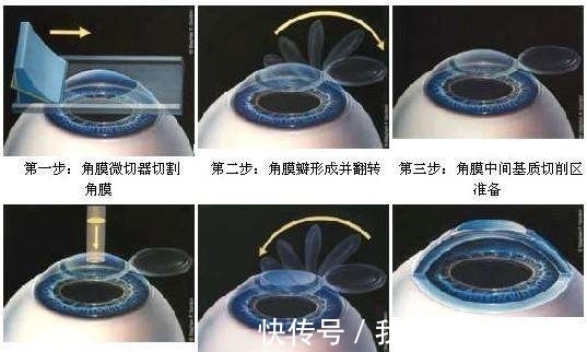 近视|曾经用激光治疗近视的人,现在后悔了吗?