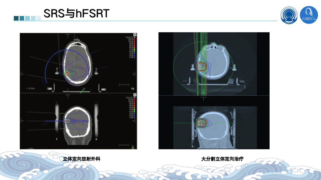 根治性|2021ASTRO丨骨脑转移瘤最新进展汇总