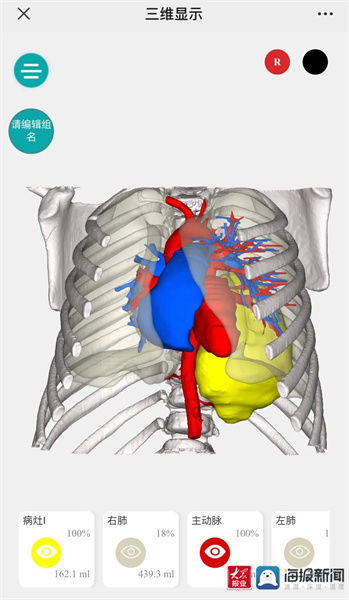 先天性|四岁男孩患肿瘤 泰安市中心医院儿外科新设备助力精准切除