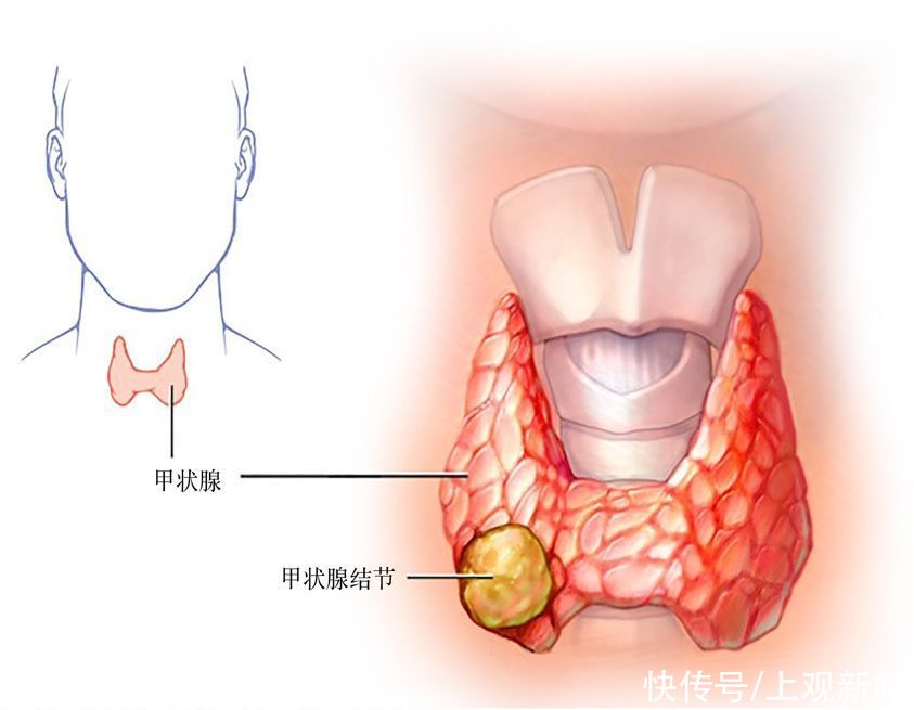  结节|七个问答，全面了解甲状腺结节