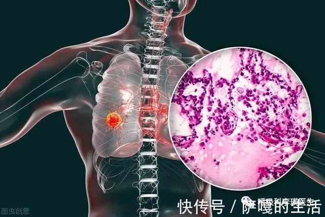 肺癌|查到肺结节就是早期的肺癌？关于肺结节的13个常识问答，你知道吗？