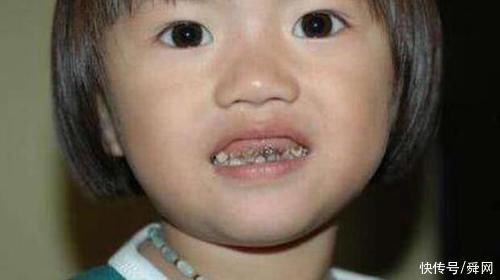 刷牙|3岁儿子满口小黑牙,送去医院检查后,医生的话让妈妈万分羞愧