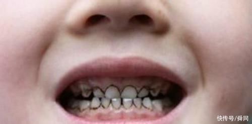 刷牙|3岁儿子满口小黑牙,送去医院检查后,医生的话让妈妈万分羞愧
