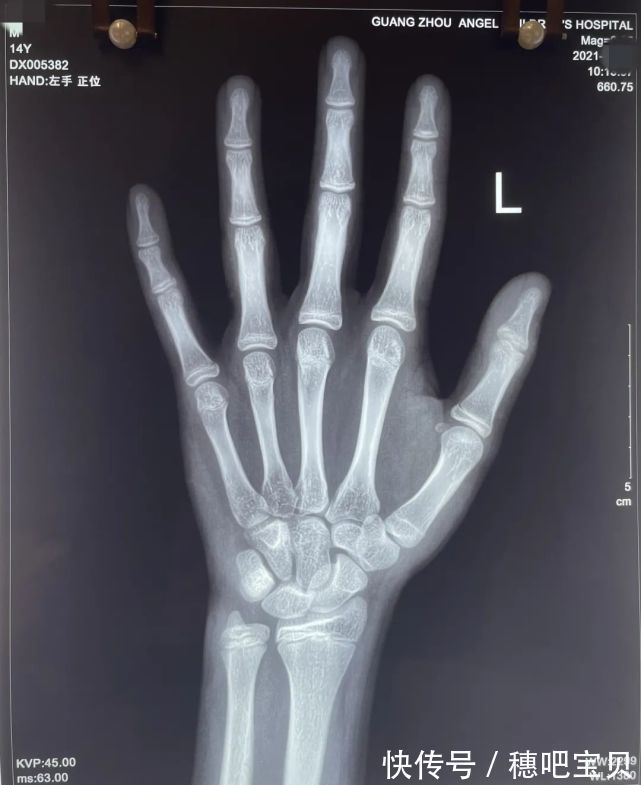 长高|14岁青春期身高落后,经科学干预,成功增高3.7厘米!看他是如何逆袭长高的!