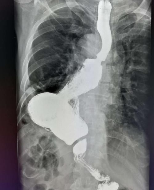 癌症患者体重增加，是好现象吧？