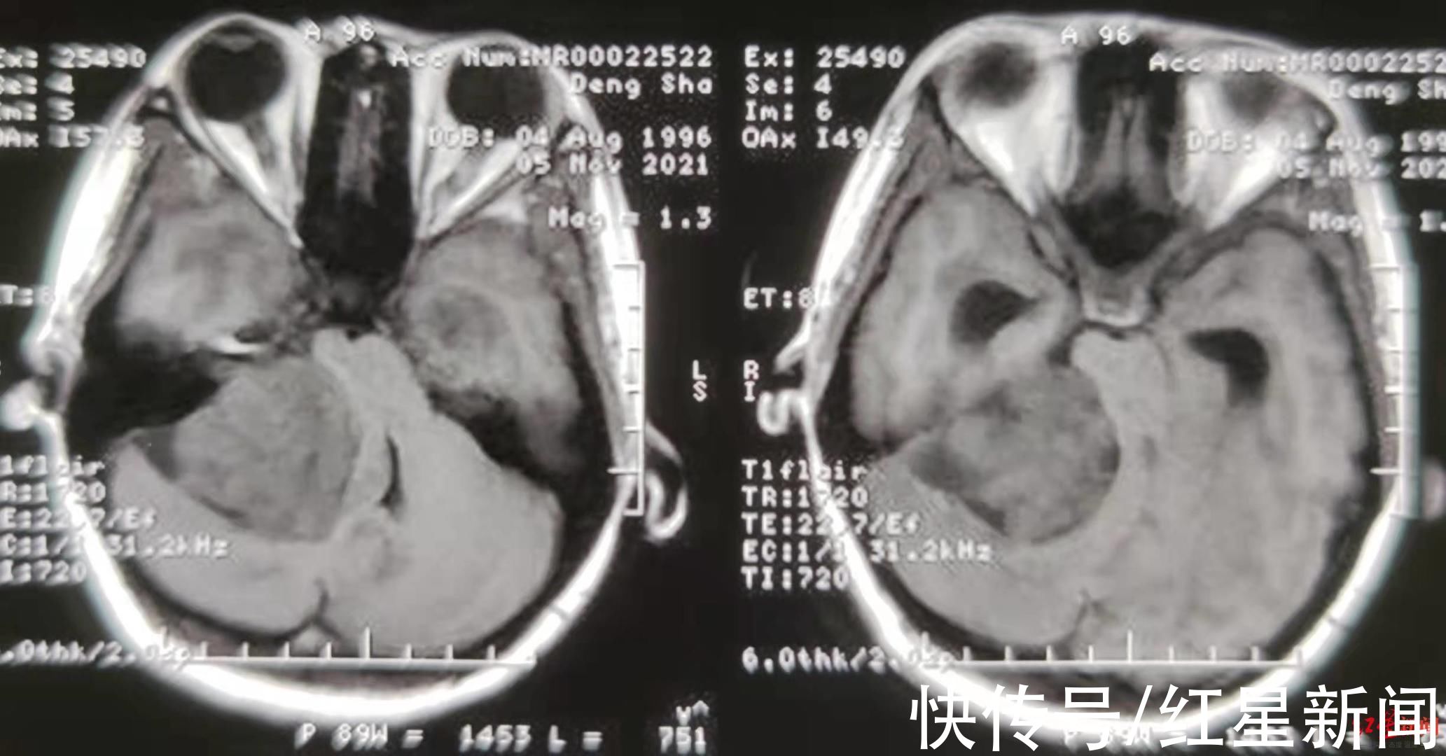 神经外科|46天生死考验：女子孕期确诊巨大听神经瘤，历经三次手术，安全生下女婴