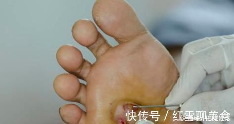 高血糖|得了糖尿病要注意,且糖尿病容易引起的并发症绝不能粗心大意!