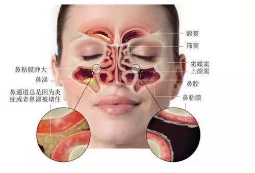 慢性鼻窦炎|天冷时，为什么即使没有感冒也会忍不住流鼻涕？