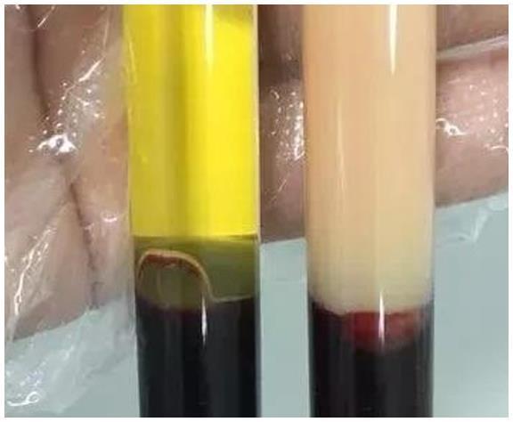 动脉硬化|血脂高不高,看脸就知道,若没有这3个症状,恭喜血脂控制得不错