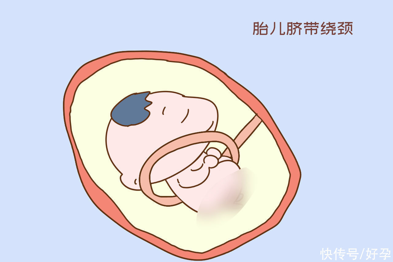 胎心监护|医生说宝宝胎心有点快是在提示什么?其中门道很深,孕妈要知道