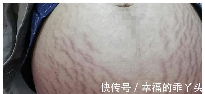 女性|为何同样都是怀孕,有些女性却不会长“妊娠纹”?孕妈要了解