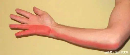 手部麻木的7种常见病因、如何鉴别及治疗