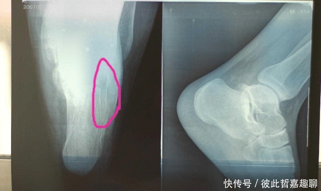 “痛苦”手术排行榜，四个之中经历一个，你可能也是很坚强的