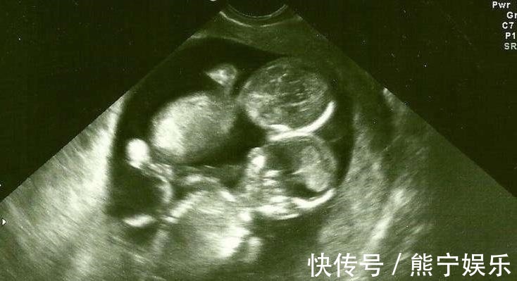 陈女生|做产检发现怀的是连体婴却仍要生,结果小孩出生那一刻所有人都!