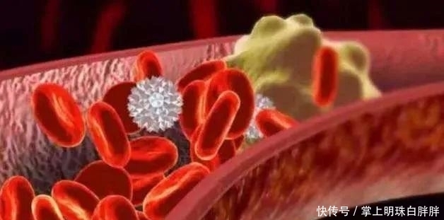 做了血脂检查怎么看报告,只要异常就需要吃药吗?