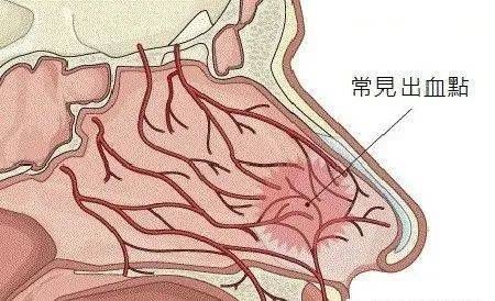 营养均衡|常见导致鼻涕带血的原因，居然这么多