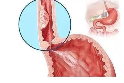 食管|食管癌症状