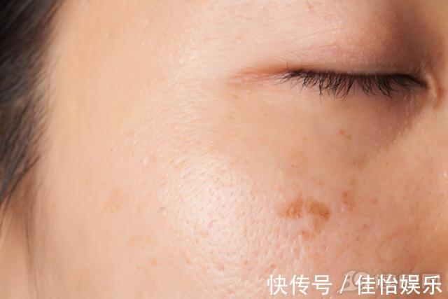 鳞状细胞癌|皮肤癌并非“悄无声息”身上有这些异常,疾病已至