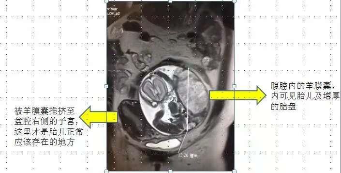 孕妇|怀孕6个月，胎儿却不在子宫？为了生孩子，命都不要了？