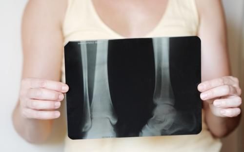 咖啡|52岁大妈严重骨质疏松,3个月后骨密度正常,看她如何做到的