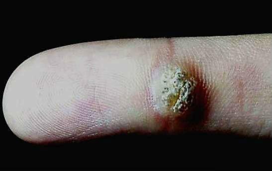 寻常疣|一味药,拿掉瘊子!这个治寻常疣的小方子,我要给读者说一说