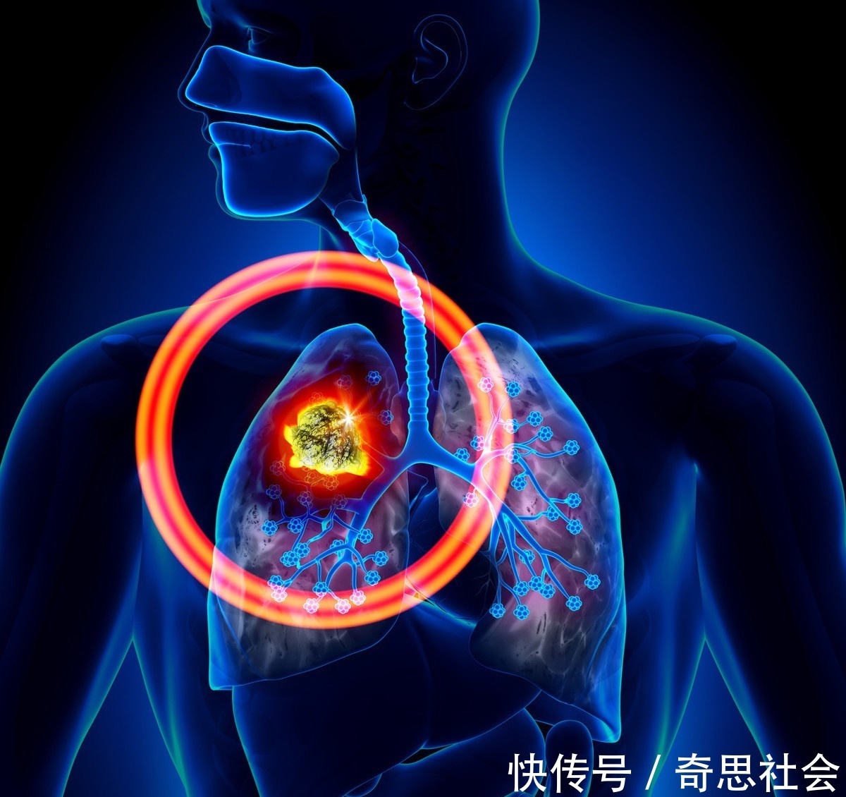 化疗|32岁小伙患肺癌,疑惑别人化疗要三天,为何自己只一天,要求加药