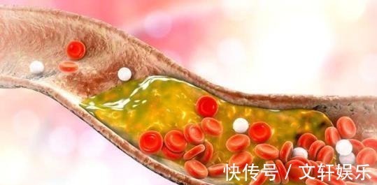 高血脂|晚上睡觉如果出现以下四种表现,八成是血脂过高,及时去医院检查