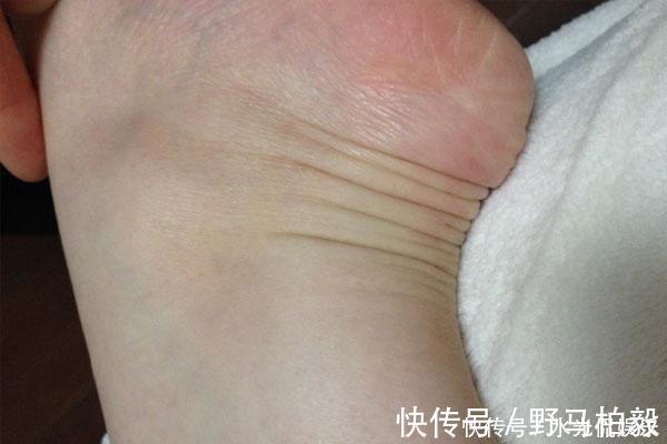 健康|人的双脚是健康“警报器”，有9种变化，说明你身体出问题了