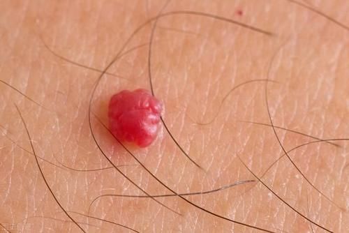 宫颈癌|女性身上若长出这样的疣体,可能是HPV病毒!别大意,趁早去检查