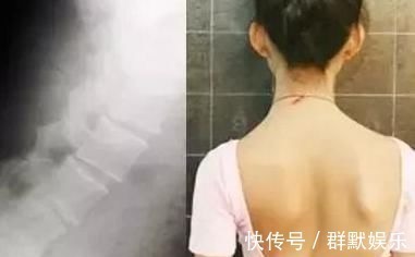 脊柱侧弯|12岁女孩弯腰时一个动作,被父母发现异常10个孩子就有2个中招