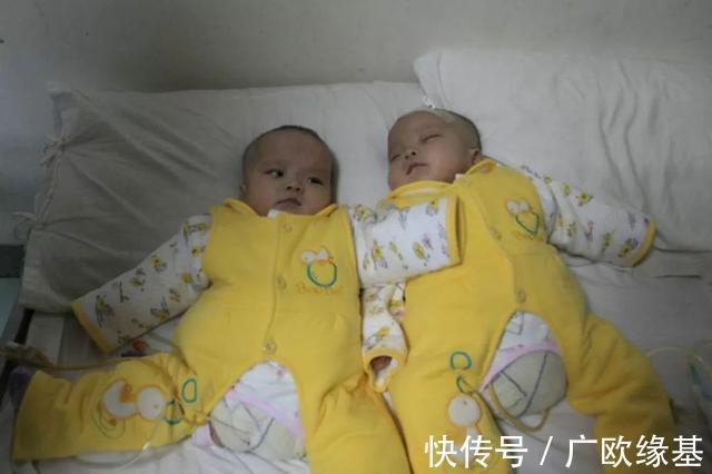 双胞胎|我国首例“坐骨连体”双胞胎,成功分开11年了,她们现在还好吗