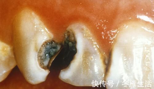 牙周|农村治牙痛的奇怪办法，1块生姜就能搞定，1分钟见效，值得一试