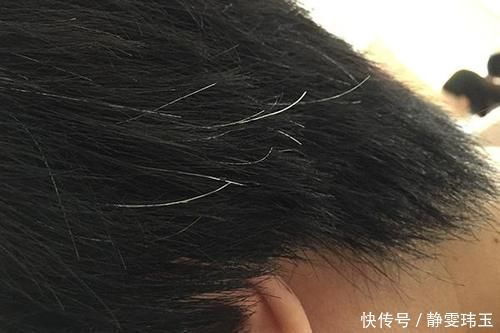 营养素|脱发、头发毛躁、白发?专家:头发出问题,多半是缺乏3种营养素