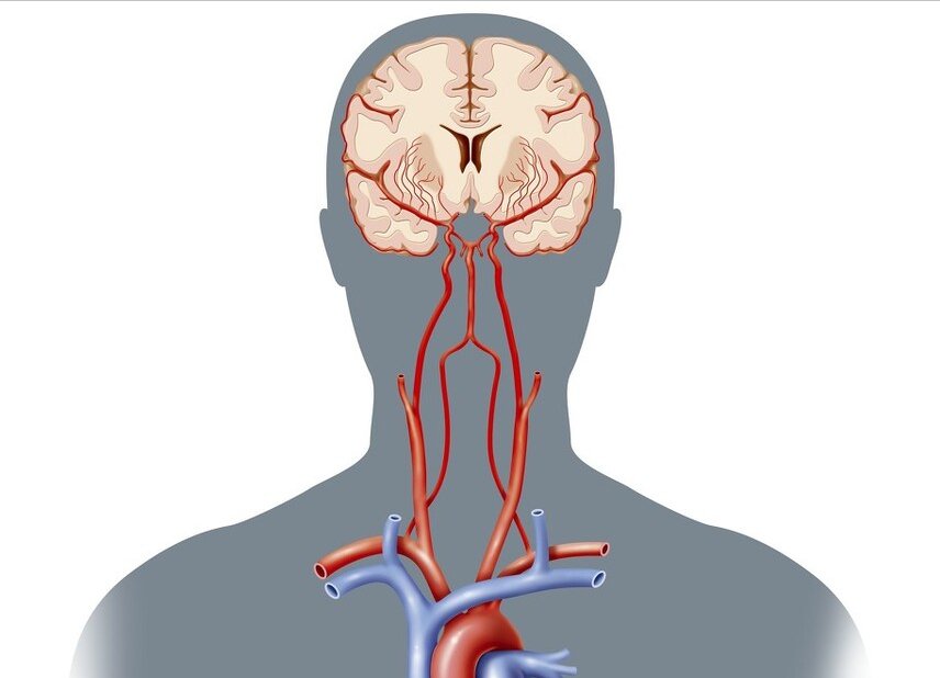 颈内动脉|按摩不当!32岁女子被按出颈动脉夹层,这个部位别轻易按摩
