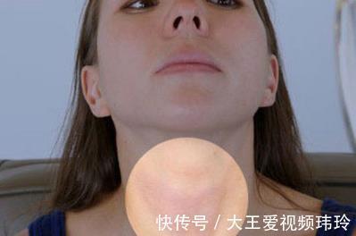 恶性肿瘤|患上这三种癌,是不幸中的万幸合理治疗,或能够好好活着