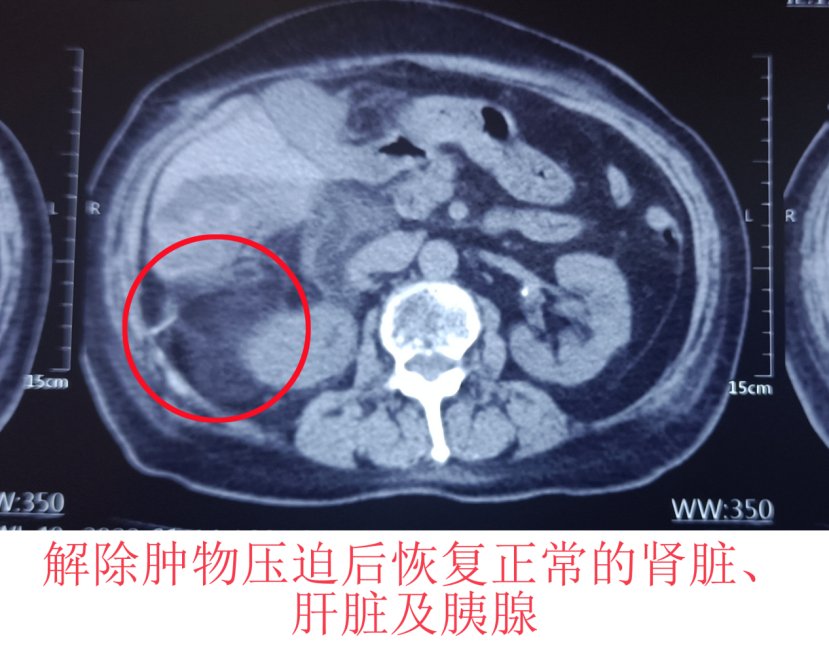 腹膜|哈医大一院群力多学科联合微创切除复杂后腹膜巨大脂肪肉瘤