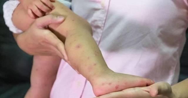 妈妈|宝宝被蚊虫叮咬后,90%妈妈都做错!擦这个止痒最有效!