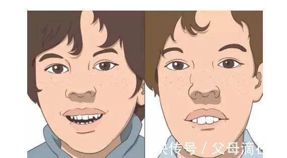 腺样体|别让漂亮的孩子变成“丑小鸭”——腺样体肥大影响孩子的容貌