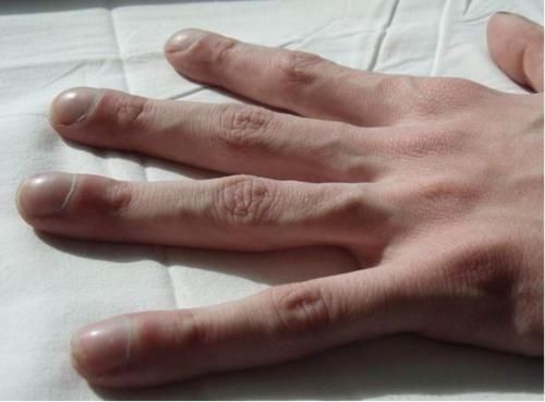 肺癌|尼古丁“很怕”一种水，并非鸭血汤，若你爱吃，排出烟毒，咳嗽痰多也没影了