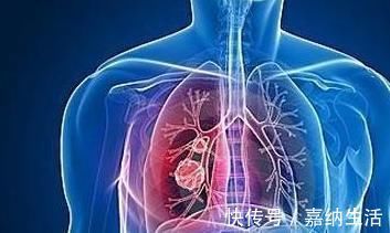 肺部结节|肺部结节遭忽视,两年后检查成变成了肺部肿瘤,谁之过