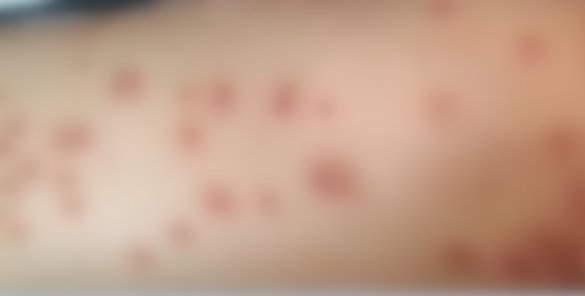 席子|女子一觉醒来，身上爆出密密麻麻红疹！和家里这样东西有关