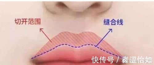 疤痕 做埋线人中缩短,术后嘴巴会不会留疤不自然?